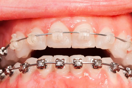 Types of Braces - What are the Best Type of Braces for Your Orthodontic  Treatment?