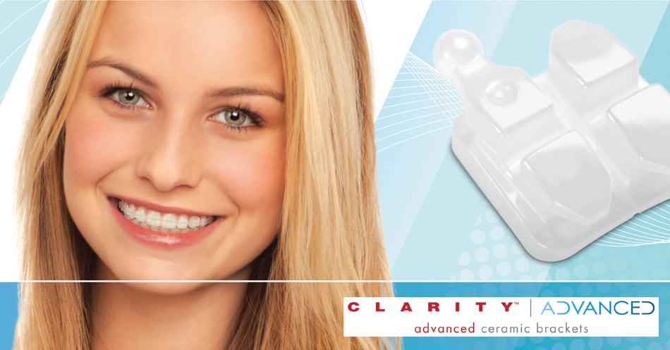 clarity advanced ceramic braces - schulhof center for orthodontics